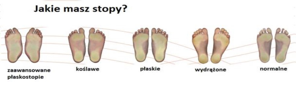 Obrazek, który przedstawia stopy ludzkie. Na zdjęciu stopy koślawe, płaskie, płaskostopie, wydrążone oraz normalne
